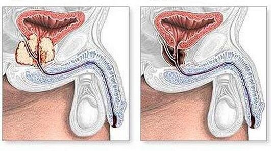 Before and after the treatment of chronic prostatitis surgically