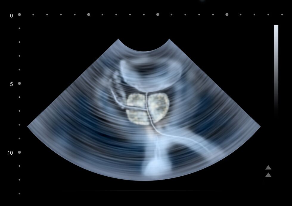 prostate diagnosis