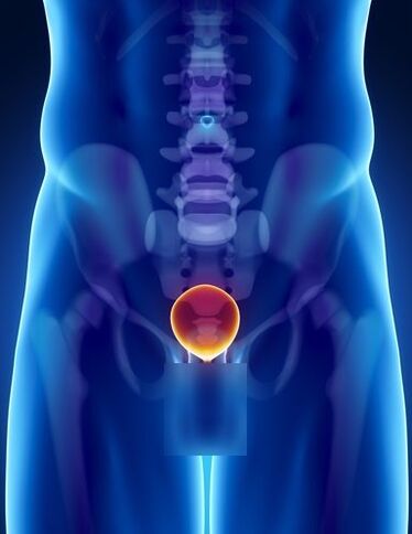 Prostate inflammation in a man with prostatitis