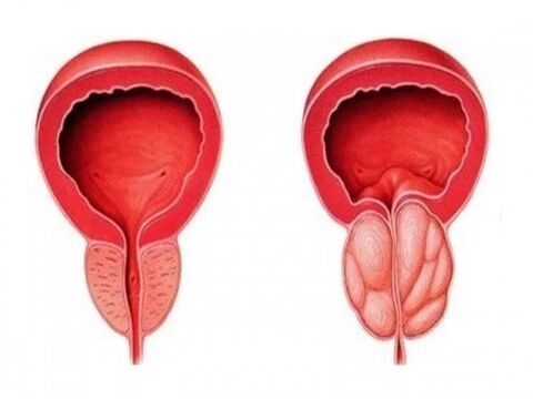 Healthy and inflamed prostate